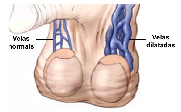 Varicocele Varicocele